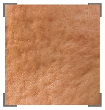 Mature Skin Uneven Texture