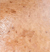 Hyperpigmentation Img