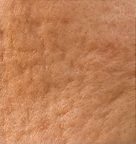 Mature Skin & Uneven Texture Img